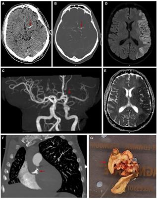 Spontaneous calcified cerebral emboli: a comprehensive review and proposed diagnostic criteria
